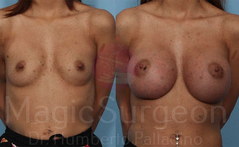 Breast Augmentation Before & After Gallery - Patient 133182441 - Image 1