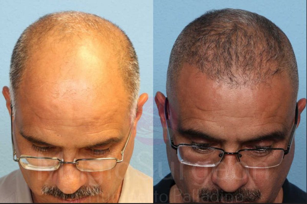 Hair Transplant Before & After Gallery - Patient 133182444 - Image 2