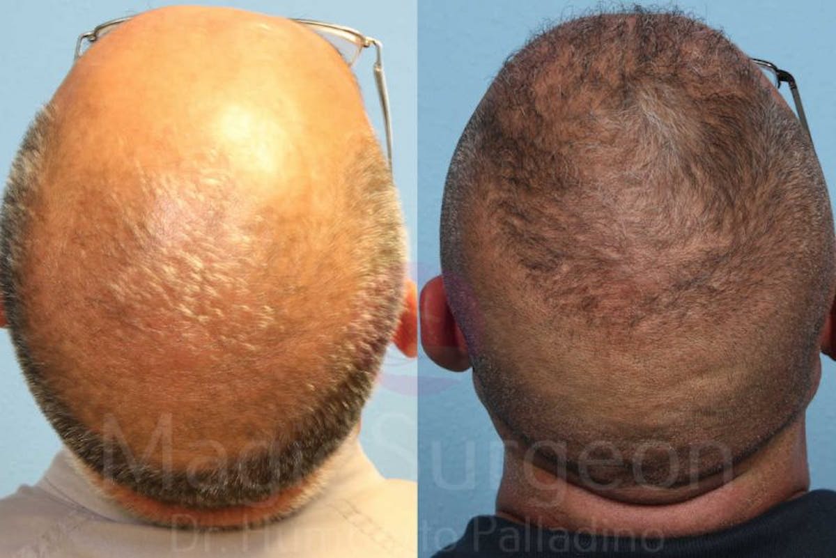Hair Transplant Before & After Gallery - Patient 133182444 - Image 3