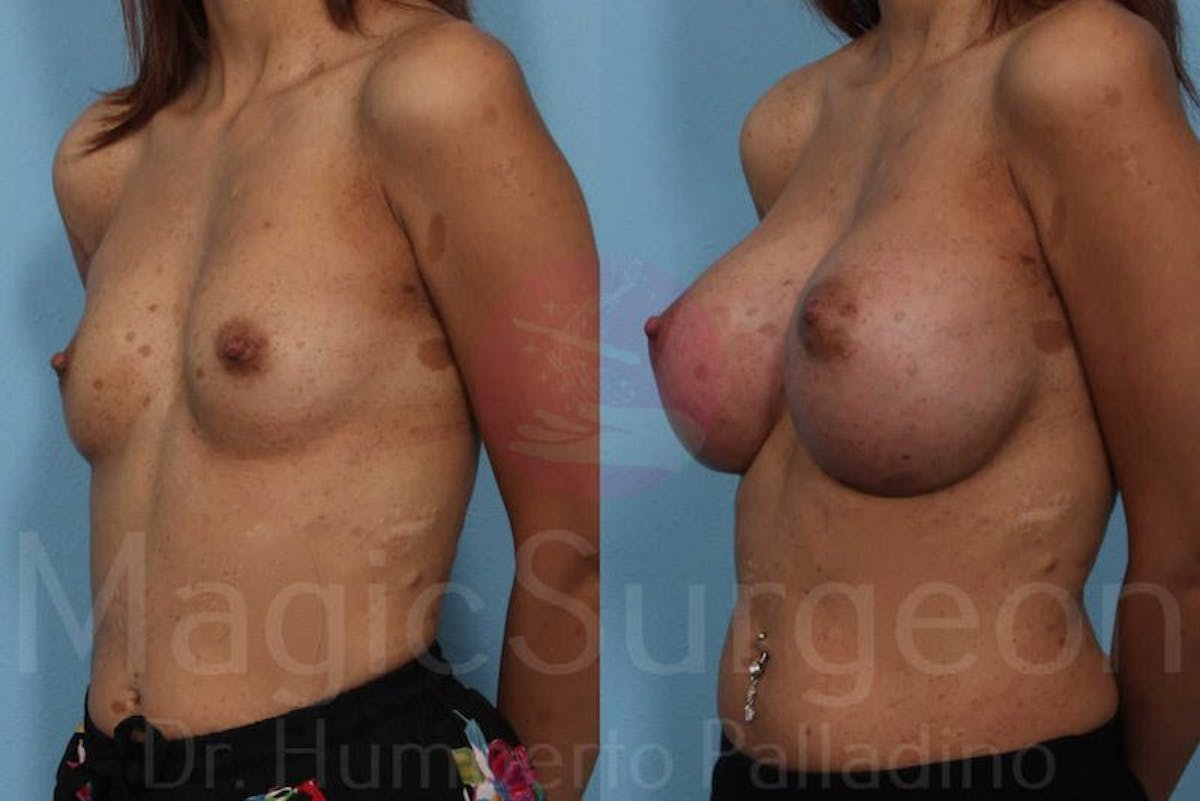 Breast Augmentation Before & After Gallery - Patient 133182441 - Image 2