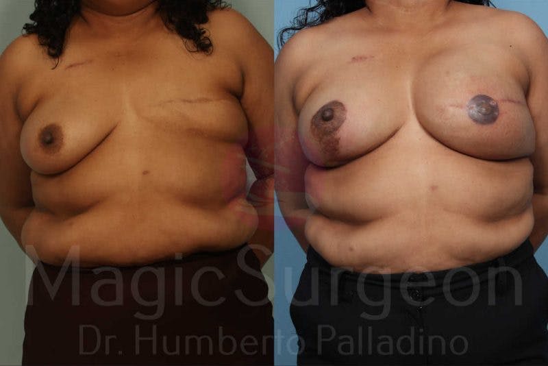 Breast Reconstruction Before & After Gallery - Patient 133182443 - Image 1