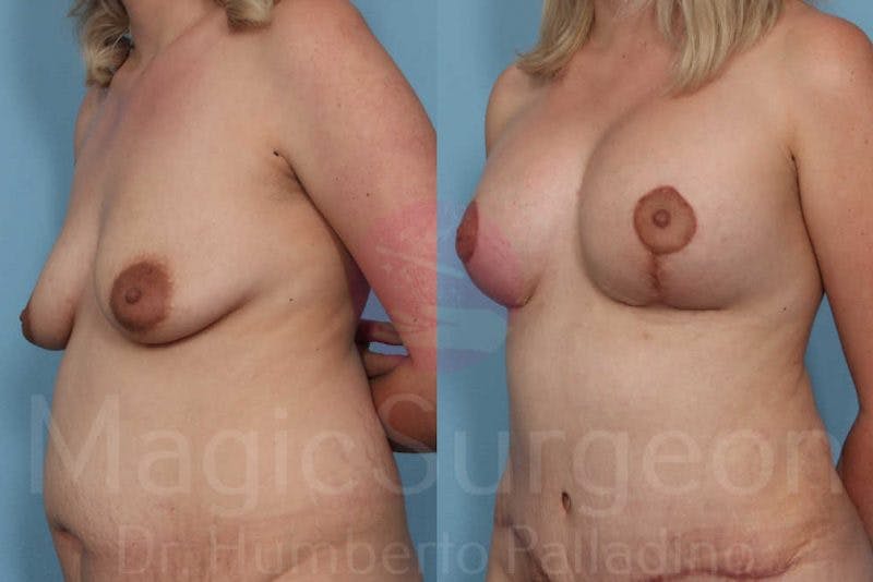 Breast Lift Before & After Gallery - Patient 133182442 - Image 2