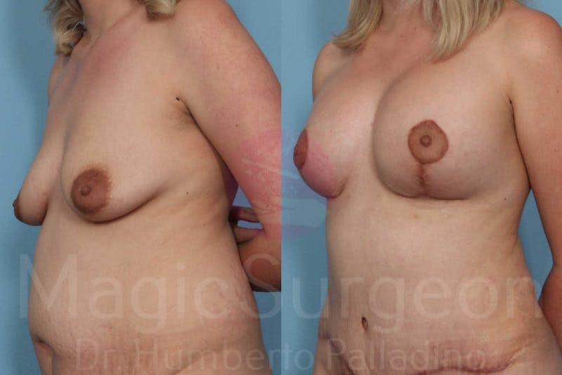 Breast Lift Before & After Gallery - Patient 133182442 - Image 2