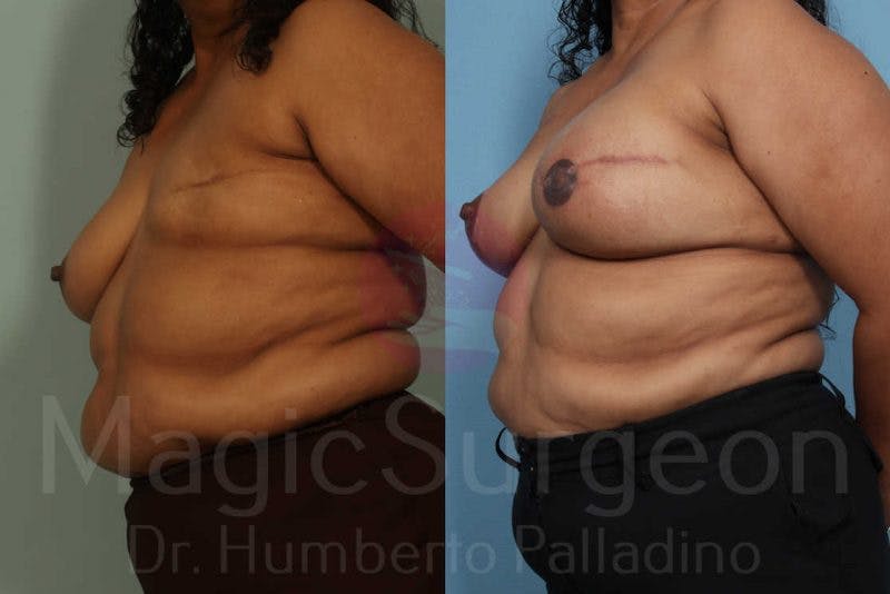 Breast Reconstruction Before & After Gallery - Patient 133182443 - Image 2