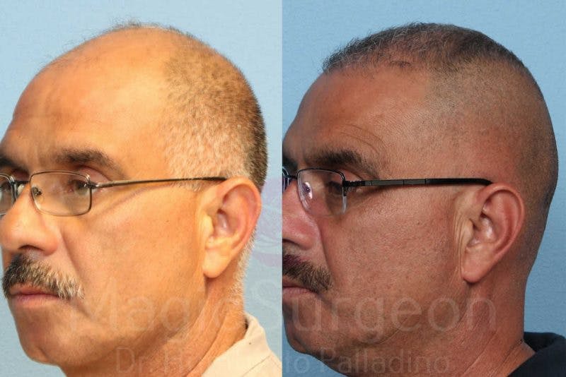 Hair Transplant Before & After Gallery - Patient 133182444 - Image 4