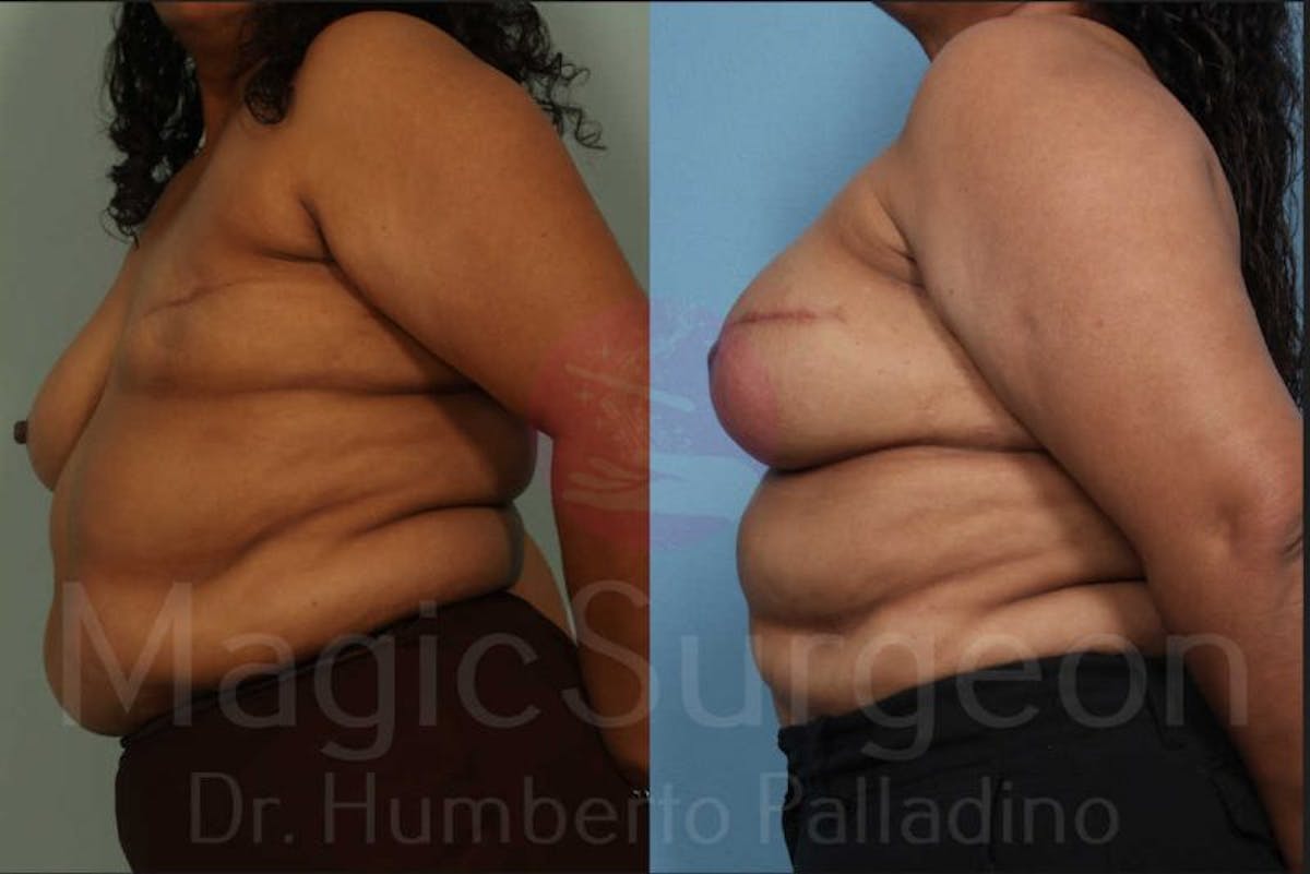 Breast Reconstruction Before & After Gallery - Patient 133182443 - Image 3