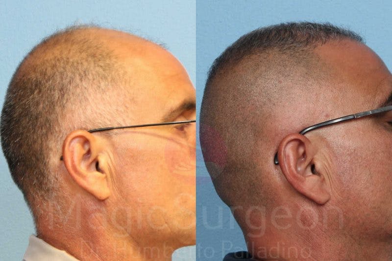 Hair Transplant Before & After Gallery - Patient 133182444 - Image 5