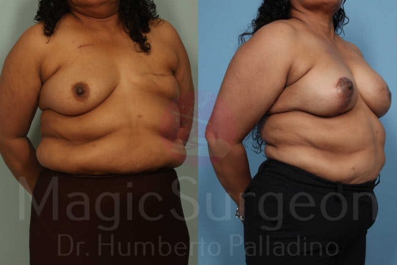 Breast Reconstruction Before & After Gallery - Patient 133182443 - Image 4