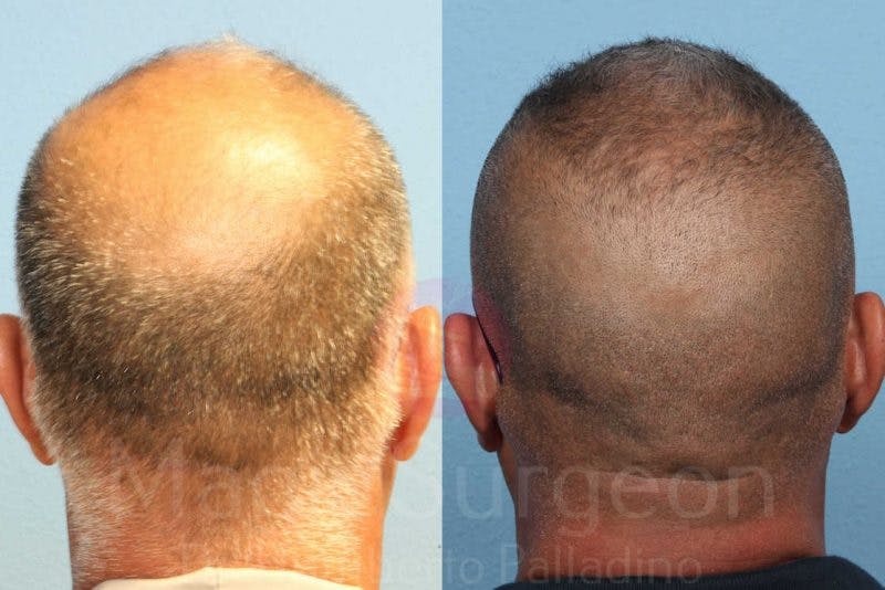 Hair Transplant Before & After Gallery - Patient 133182444 - Image 6