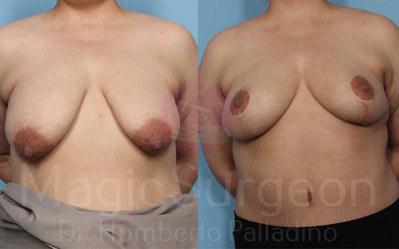 Breast Lift Before & After Gallery - Patient 133182447 - Image 1