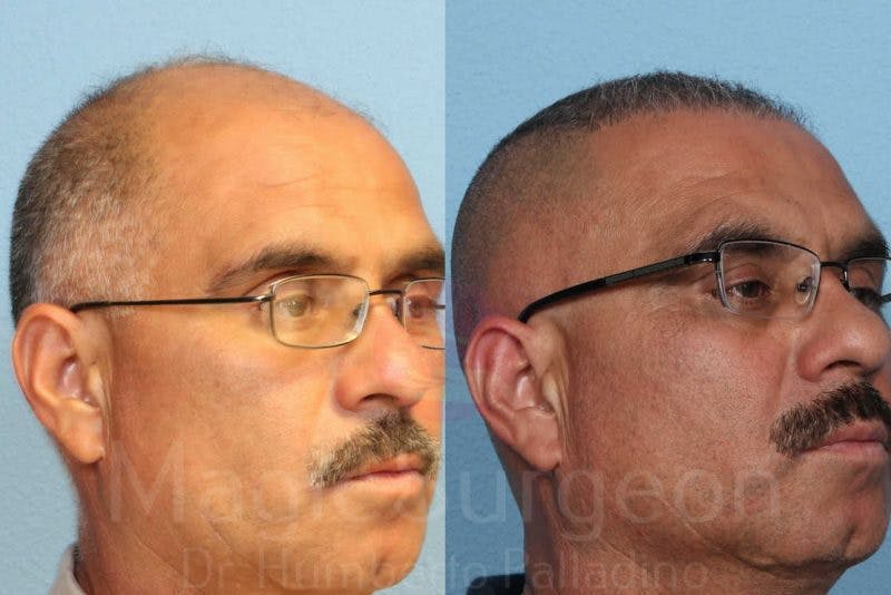 Hair Transplant Before & After Gallery - Patient 133182444 - Image 7