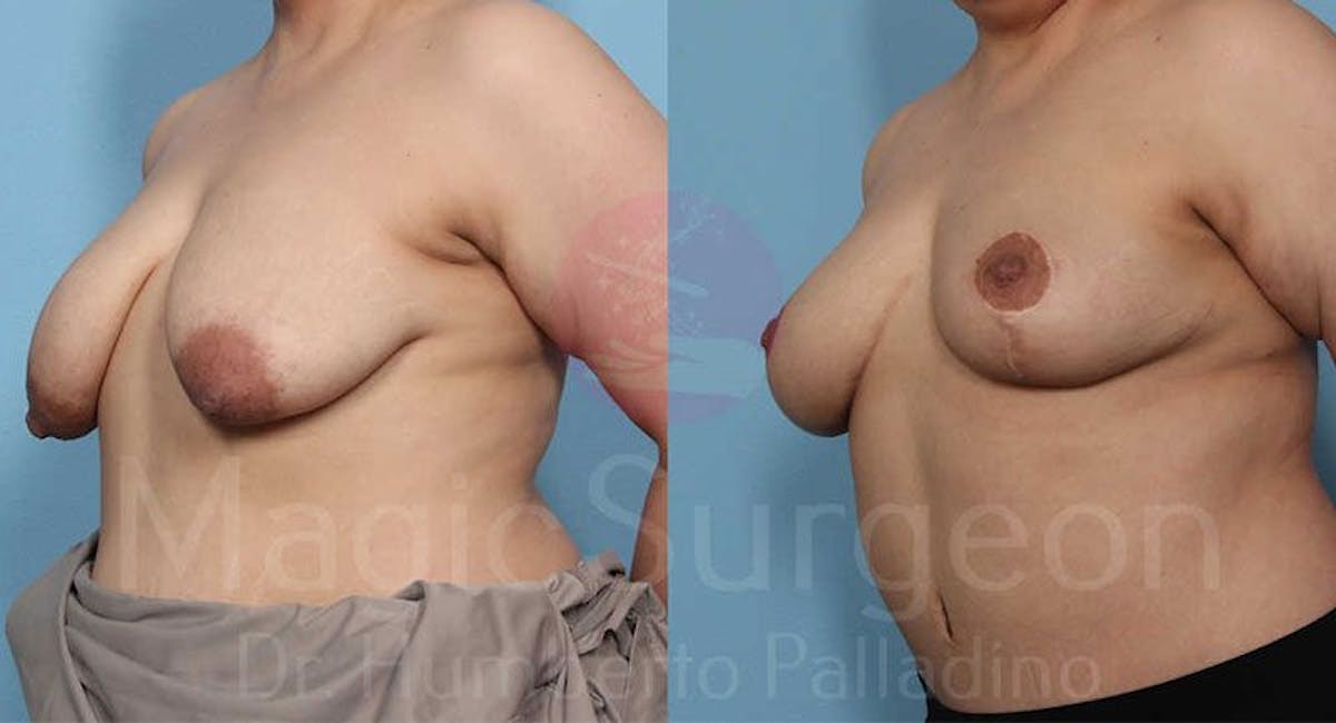 Breast Lift Before & After Gallery - Patient 133182447 - Image 2