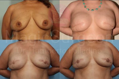 Breast Reconstruction Before & After Gallery - Patient 133182445 - Image 1