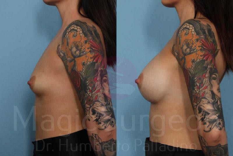 Breast Augmentation Before & After Gallery - Patient 133182449 - Image 3