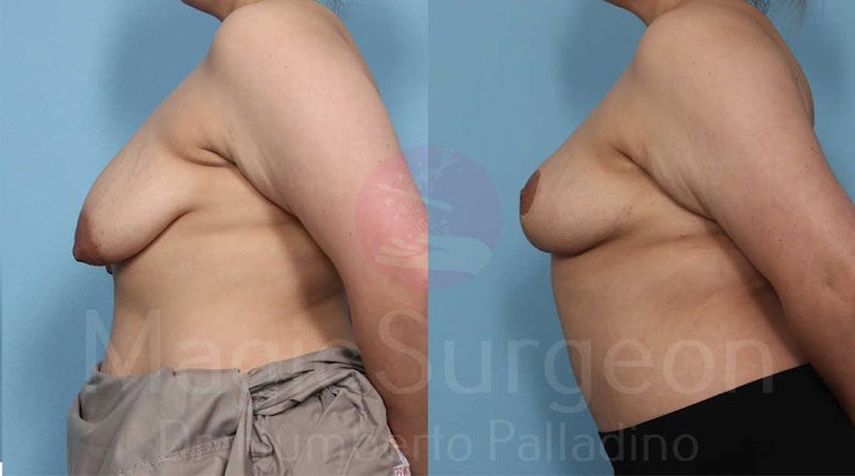 Breast Lift Before & After Gallery - Patient 133182447 - Image 3