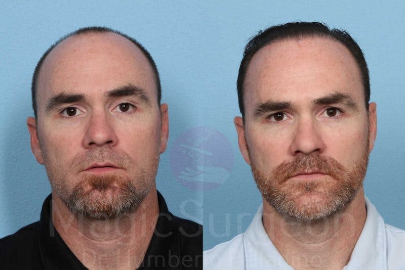 Hair Transplant Before & After Gallery - Patient 133182451 - Image 1