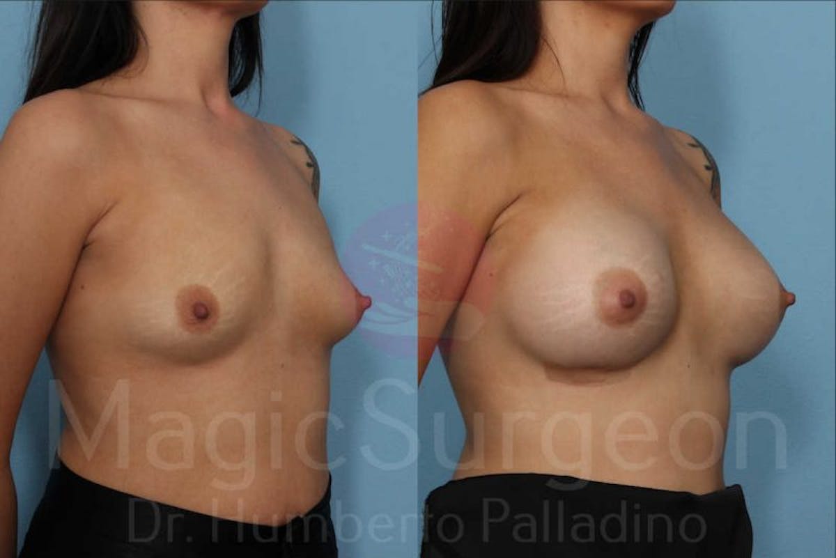 Breast Augmentation Before & After Gallery - Patient 133182449 - Image 4