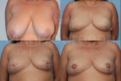 Breast Reconstruction Before & After Gallery - Patient 133182448 - Image 1