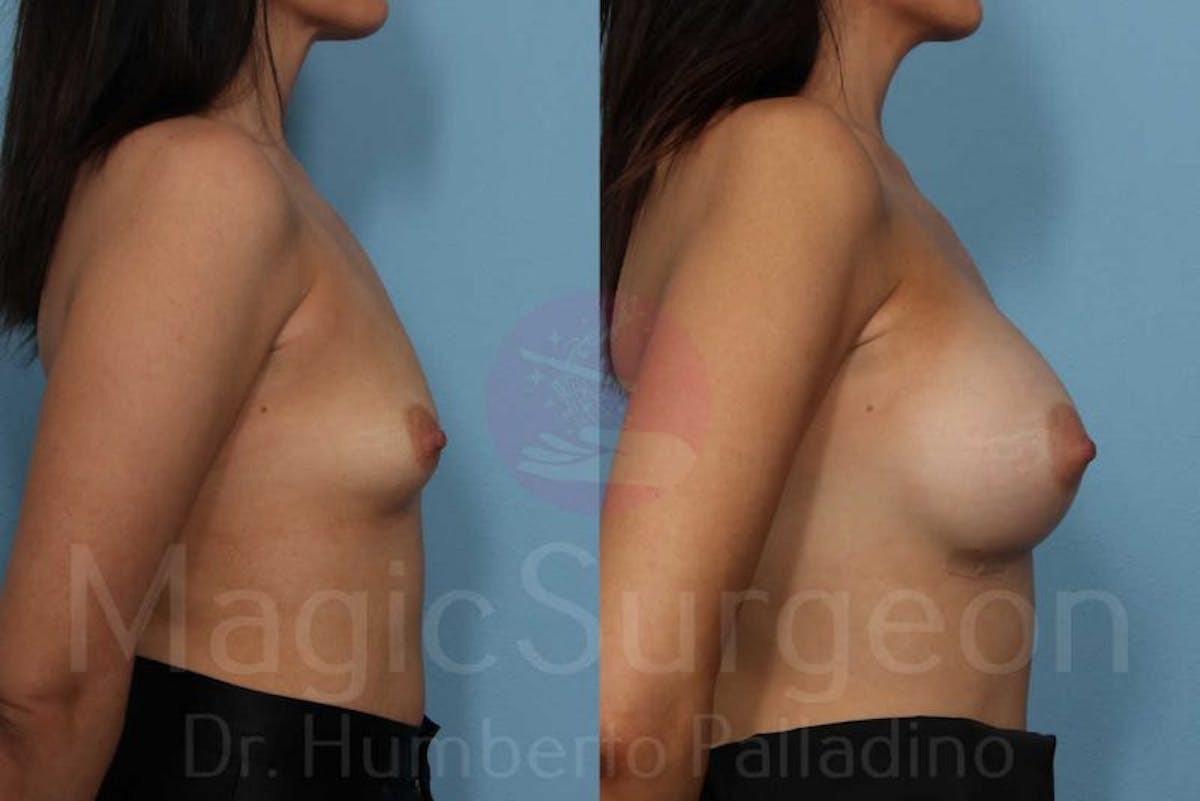 Breast Augmentation Before & After Gallery - Patient 133182449 - Image 5