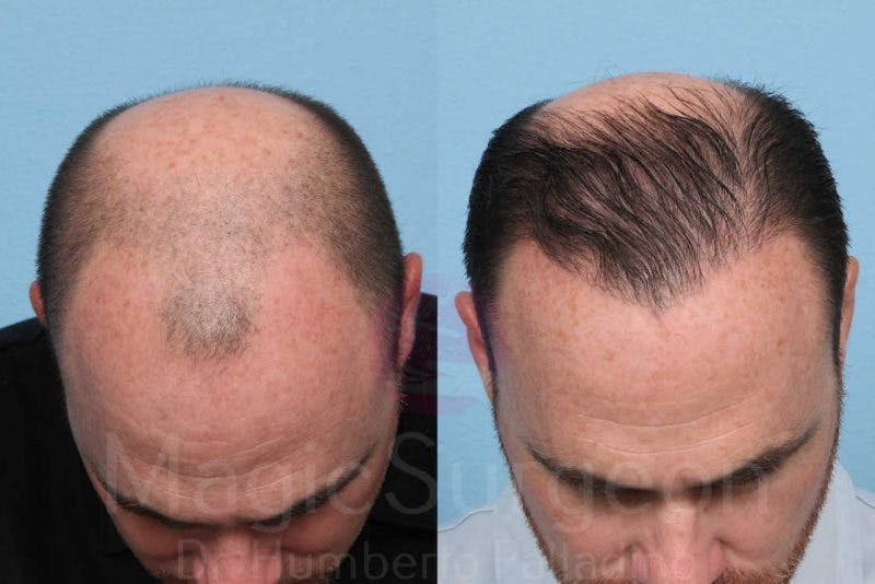 Hair Transplant Before & After Gallery - Patient 133182451 - Image 2