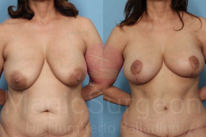 Breast Lift Before & After Gallery - Patient 133182452 - Image 1