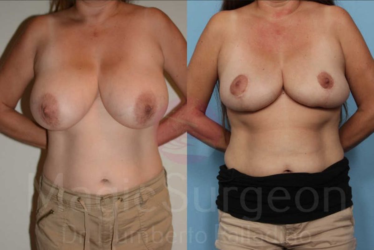 Breast Reduction Before & After Gallery - Patient 133182453 - Image 1