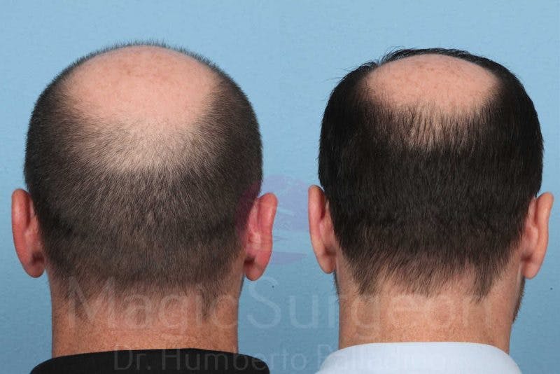 Hair Transplant Before & After Gallery - Patient 133182451 - Image 3