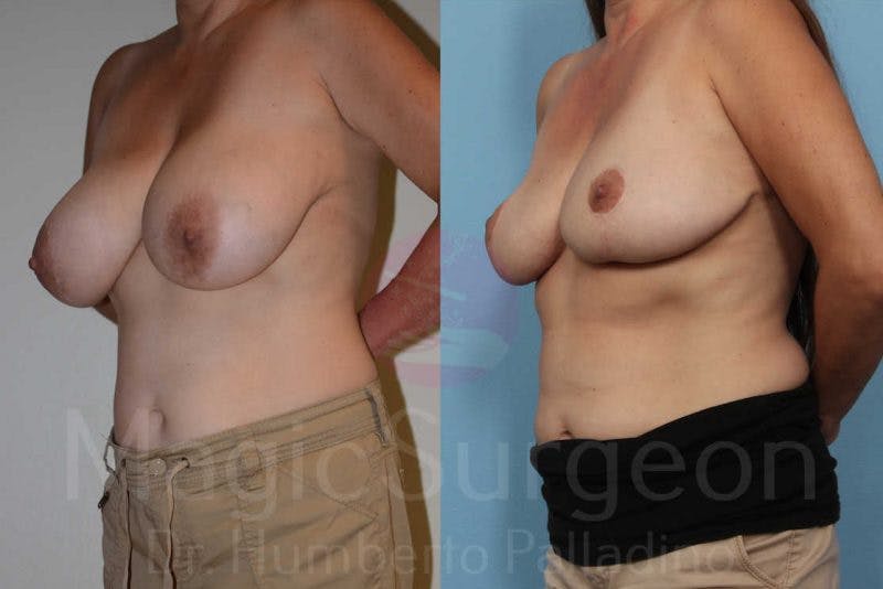 Breast Reduction Before & After Gallery - Patient 133182453 - Image 2