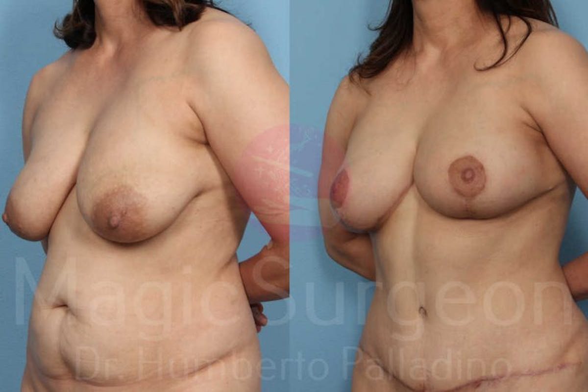 Breast Lift Before & After Gallery - Patient 133182452 - Image 2
