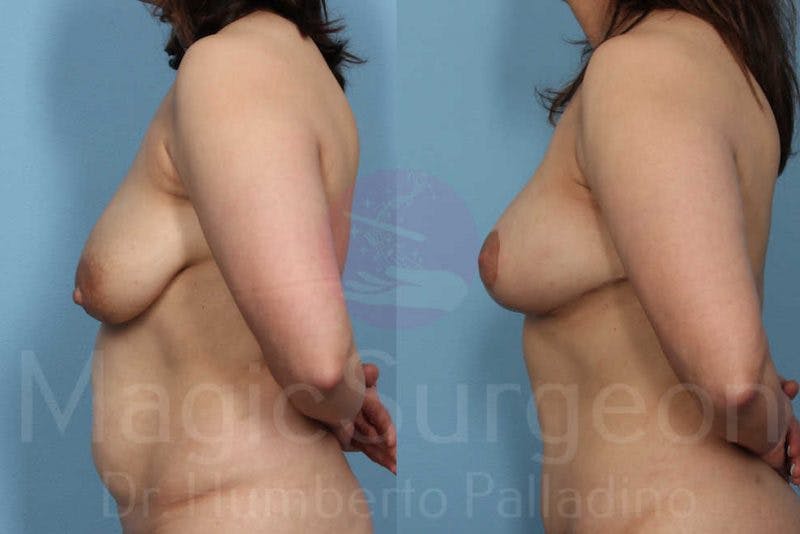 Breast Lift Before & After Gallery - Patient 133182452 - Image 3
