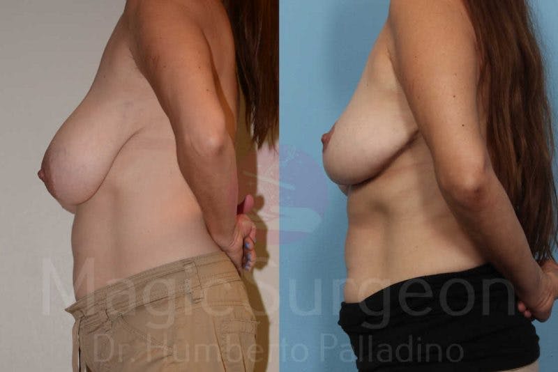 Breast Reduction Before & After Gallery - Patient 133182453 - Image 3