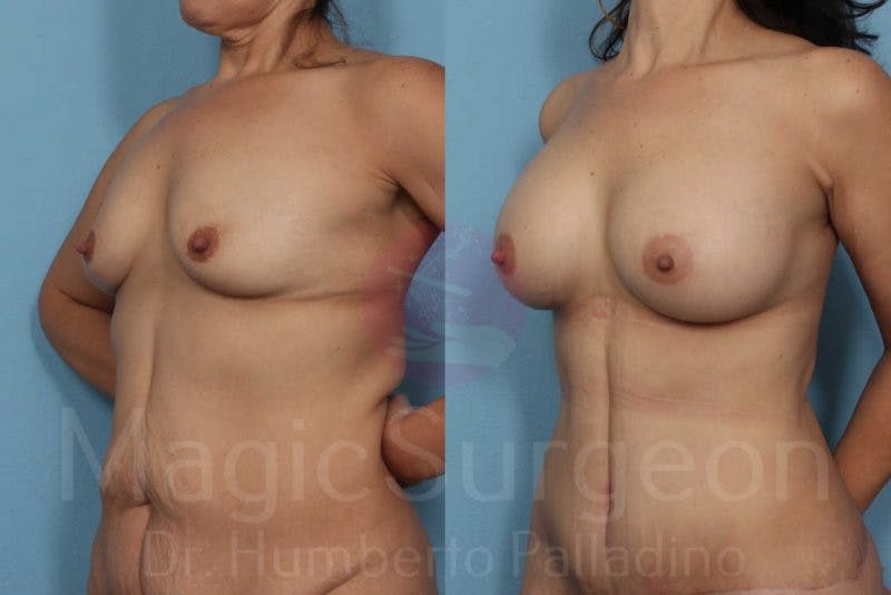 Breast Augmentation Before & After Gallery - Patient 133182454 - Image 2