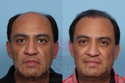 Hair Transplant Before & After Gallery - Patient 133182455 - Image 1