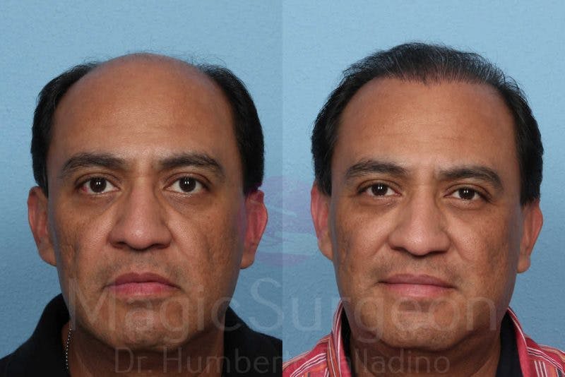 Hair Transplant Before & After Gallery - Patient 133182455 - Image 1