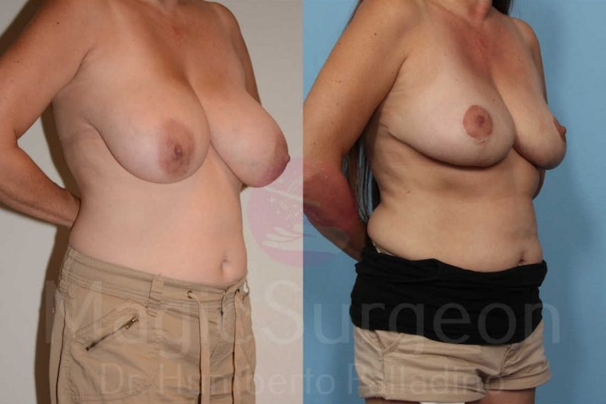 Breast Reduction Before & After Gallery - Patient 133182453 - Image 4