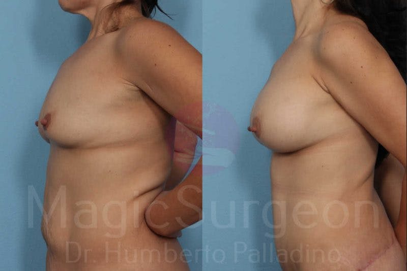 Breast Augmentation Before & After Gallery - Patient 133182454 - Image 3
