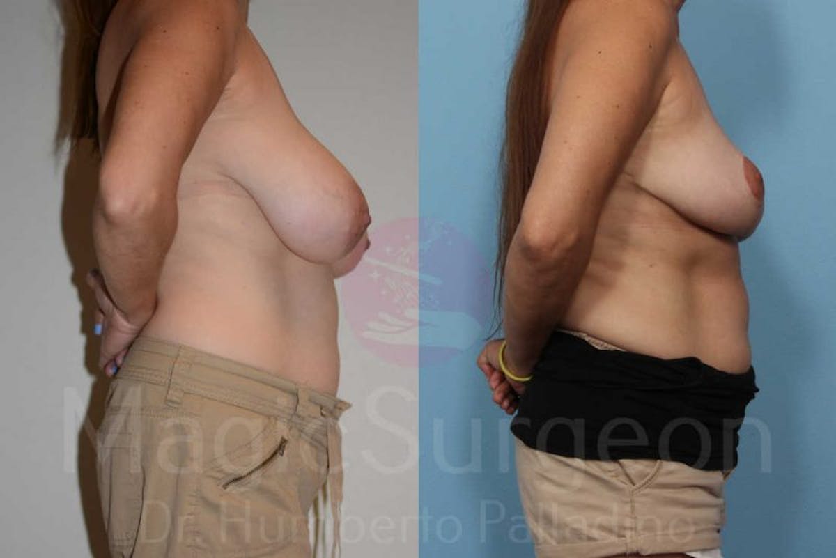 Breast Reduction Before & After Gallery - Patient 133182453 - Image 5
