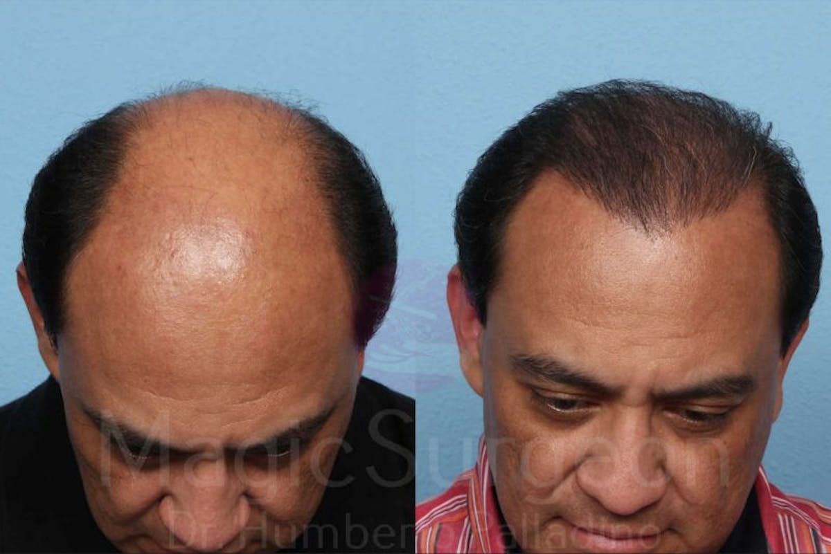 Hair Transplant Before & After Gallery - Patient 133182455 - Image 2