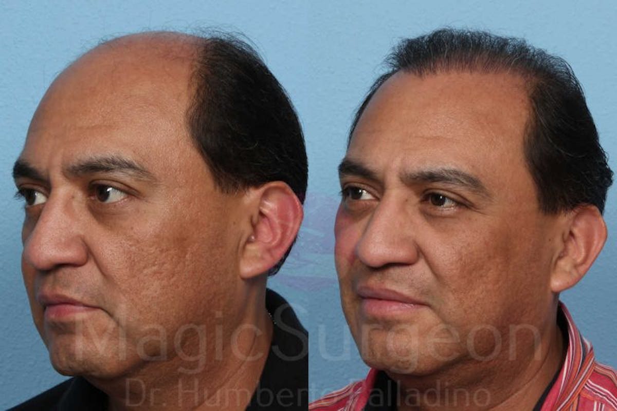 Hair Transplant Before & After Gallery - Patient 133182455 - Image 3