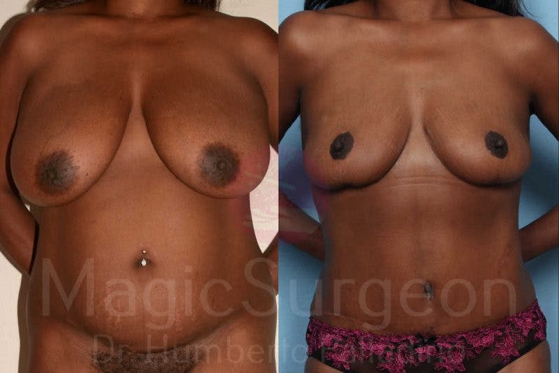 Breast Reduction Before & After Gallery - Patient 133182462 - Image 1