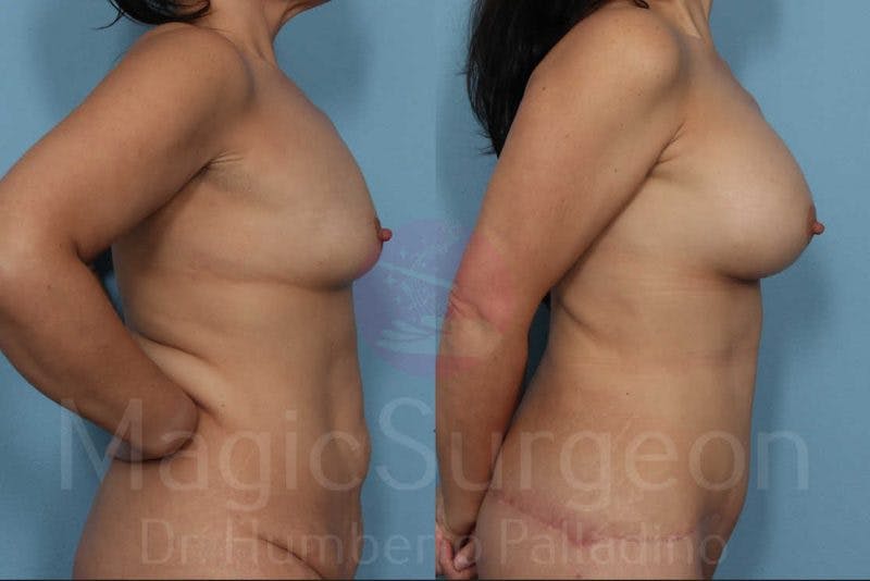 Breast Augmentation Before & After Gallery - Patient 133182454 - Image 5
