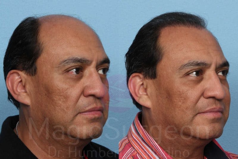 Hair Transplant Before & After Gallery - Patient 133182455 - Image 4