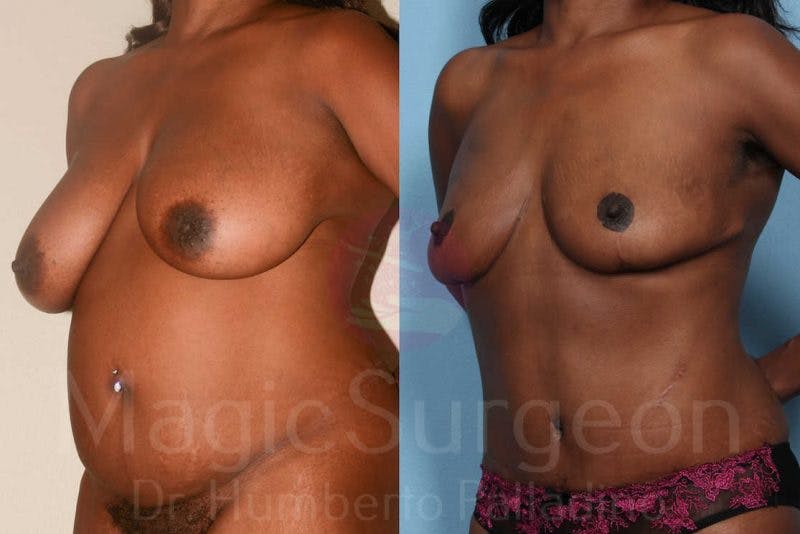 Breast Reduction Before & After Gallery - Patient 133182462 - Image 2