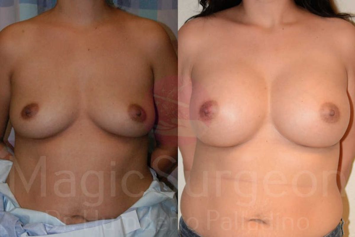 Breast Augmentation Before & After Gallery - Patient 133182463 - Image 1