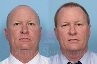 Hair Transplant Before & After Gallery - Patient 133182461 - Image 1