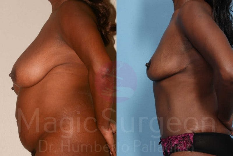 Breast Reduction Before & After Gallery - Patient 133182462 - Image 3