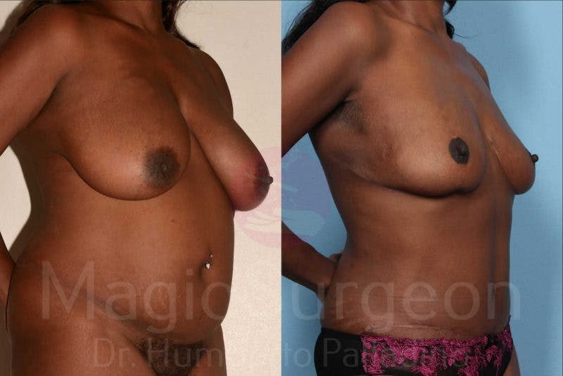 Breast Reduction Before & After Gallery - Patient 133182462 - Image 4