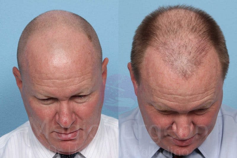 Hair Transplant Before & After Gallery - Patient 133182461 - Image 2