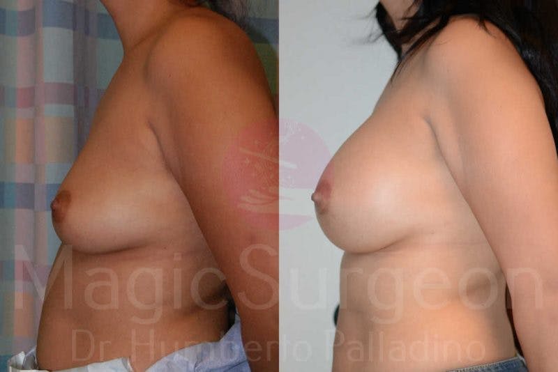 Breast Augmentation Before & After Gallery - Patient 133182463 - Image 3