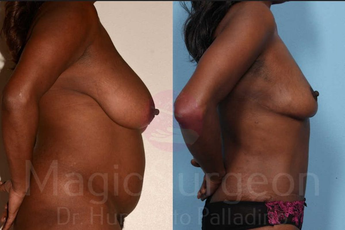 Breast Reduction Before & After Gallery - Patient 133182462 - Image 5